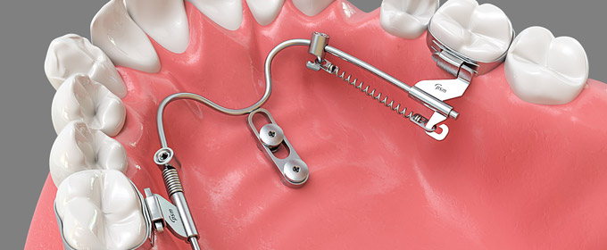 Non-Compliance: bei schwerer Zahnfehlstellung in Backnang